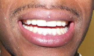 Before After Dental Case