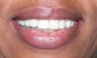 Before After Dental Case