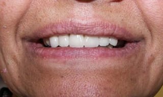 Before After Dental Case