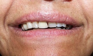 Before After Dental Case