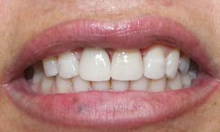 Before After Dental Case