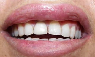 Before After Dental Case