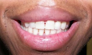 Before After Dental Case