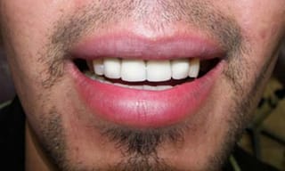 Before After Dental Case