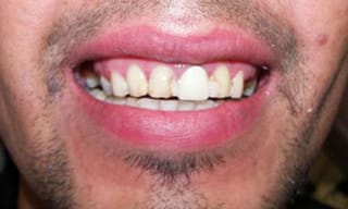 Before After Dental Case