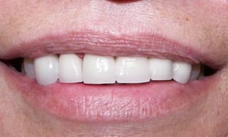 Before After Dental Case